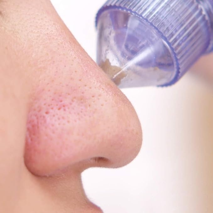 BELOXY 4 In 1 Multi-Function Blackhead Whitehead Extractor Remover Device Facial Cleansing Tool,Skin Cleaner,Pimple Removal Tool,Acne Pimple Pore Cleaner Vacuum Suction Tool For Men & Women (White)